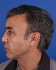 After Hair Transplant&nbsp;Front